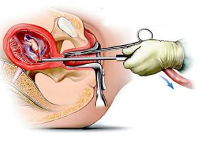 بارداری ناخواسته سقط جنین