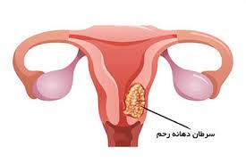 عوامل ناباروری زنان