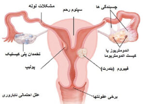 عوامل ناباروری زنان