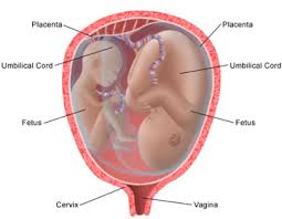 سزارین و حالت بریج.بارداری چند قلویی