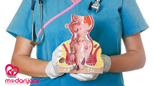 هموروئید یا بواسیر بعد از زایمان