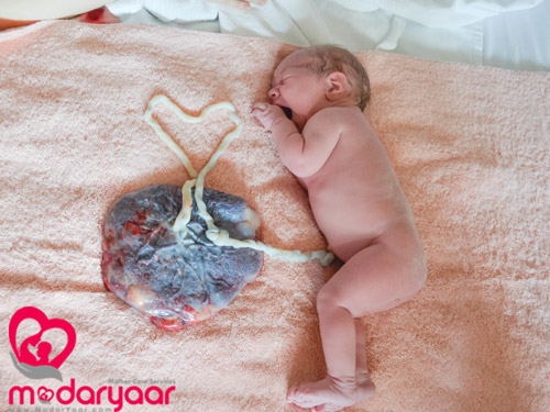 ذخیره خون بند ناف نوزاد