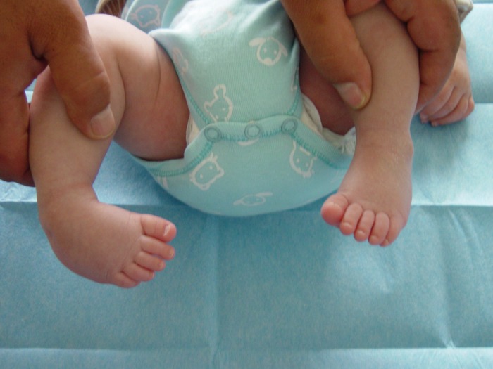 پا چنبری در نوزادان