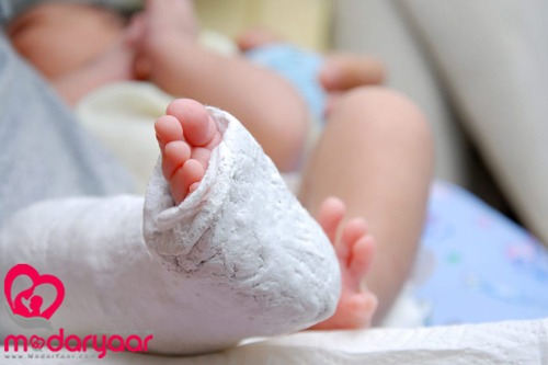 پا چنبری در نوزادان