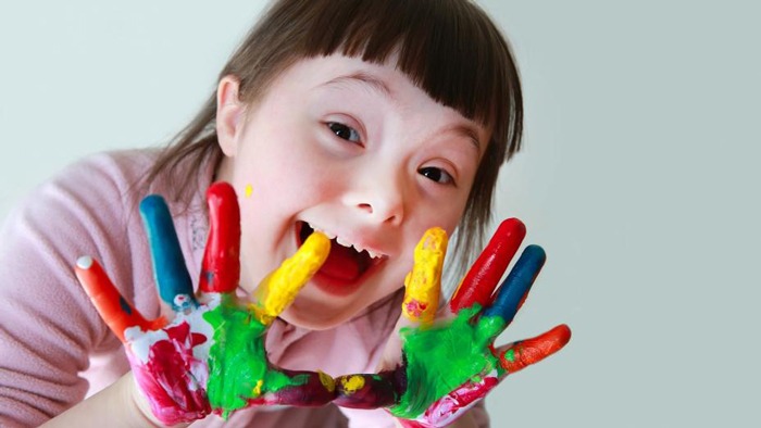 کودک سندروم داون